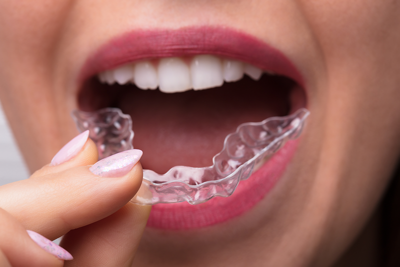 A woman is holding a clear aligner in her mouth, learning about braces in Tijuana.