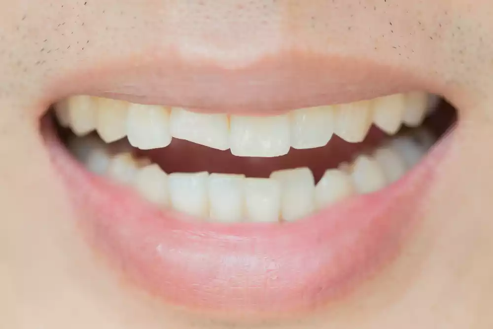 Close-up of a smiling person's mouth showing healthy teeth, with a focus on slightly uneven upper front teeth in an auto draft.