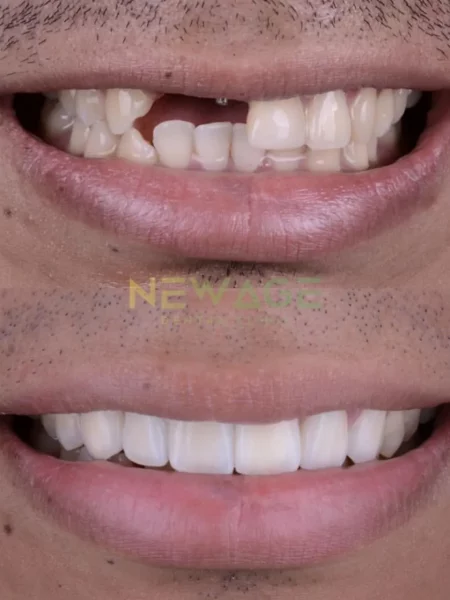 Before and after dental implants for a man's teeth transformation.